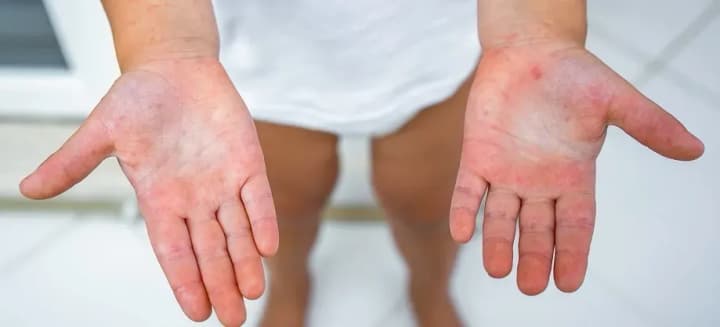 the-incidence-of-scarlet-fever-in-odesa-region-is-increasing