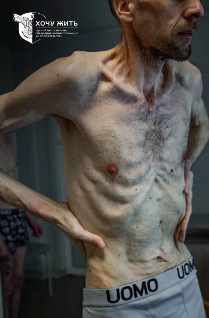 the-project--i-want-to-live-showed-a-photo-of-ukrainian-roman-gorlik-after-two-years-in-russian-captivity