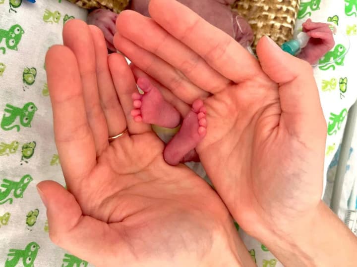 it-was-placed-in-my-mothers-palm-in-lviv-doctors-saved-a-girl-who-was-born-at-the-24th-week-and-weighed-only-600-grams