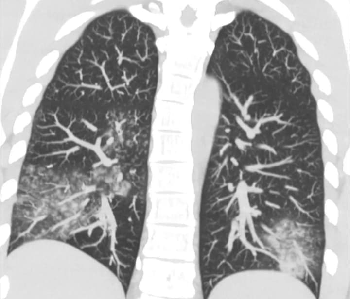 v-ukraine-zafiksirovano-13-sluchaev-opasnogo-metapnevmovirusa-kto-v-zone-riska