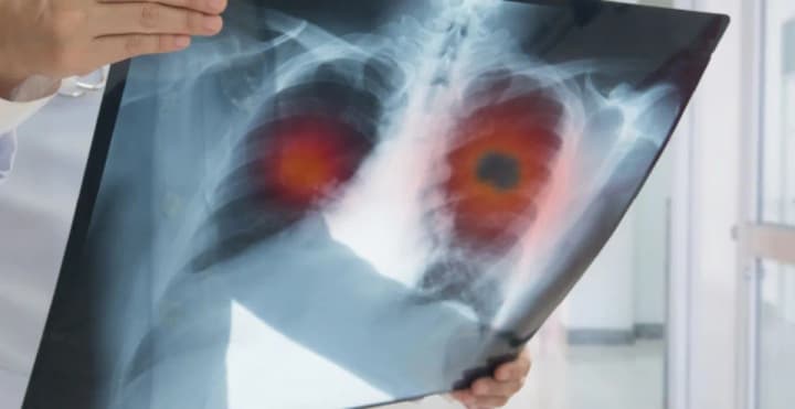 lung-cancer-diagnoses-are-on-the-rise-among-people-who-have-never-smoked-scientists-are-looking-for-a-reason