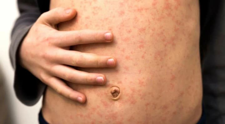 a-10-year-old-child-dies-of-measles-in-bukovyna
