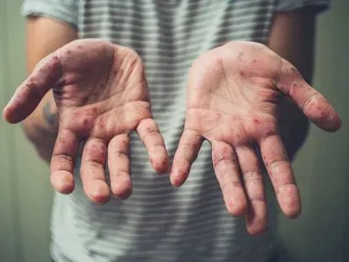 measles-incidence-is-likely-to-increase-in-the-coming-weeks-immunologist