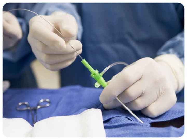 endovaskuliarna-khirurhiia-u-tsentri-shalimova-poiasnyly-perevahy-miniinvazyvnykh-operatsii