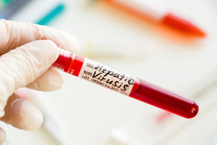 na-zakarpatti-cherez-hepatyt-a-zaboronyly-vesillia-ta-vvely-karantyn-u-shkolakh