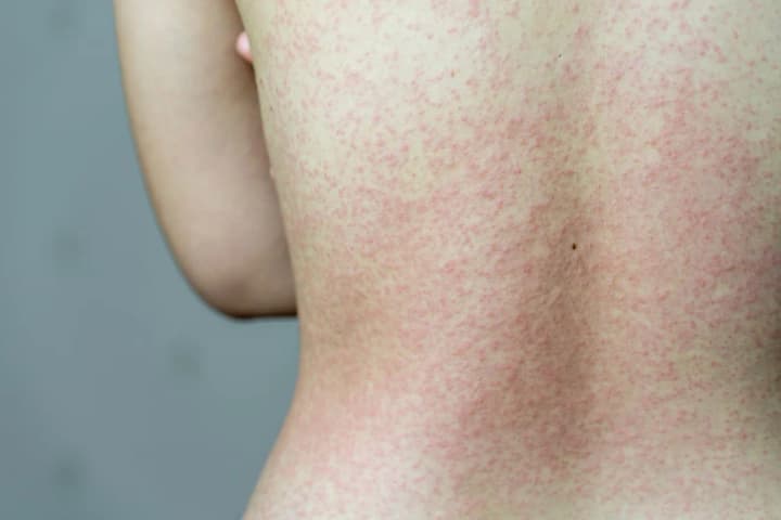 ahead-of-holiday-season-travellers-to-europe-warned-of-measles-surge-bbc