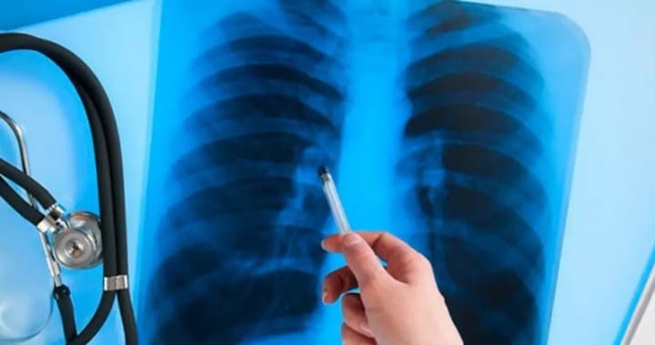in-ukraine-over-1300-people-with-tuberculosis-were-registered-in-june