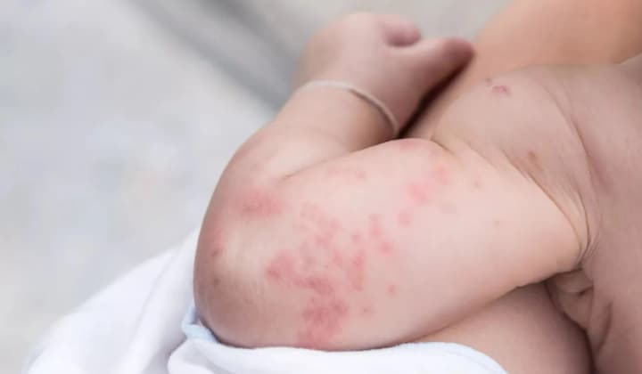after-covid-19-a-dangerous-skin-lesion-developed-doctors-saved-an-infant-from-lviv-region
