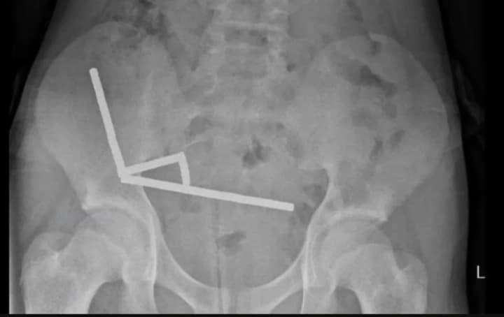 in-new-zealand-a-boy-who-swallowed-100-magnets-that-then-linked-together-in-his-intestines-underwent-surgery