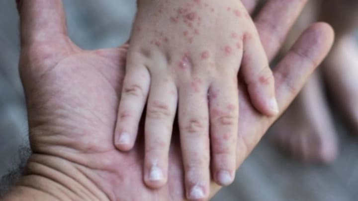 coxsackie-disease-outbreak-in-kyiv-region-13-children-fell-ill-one-still-in-hospital