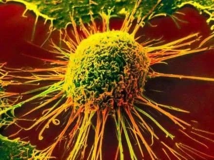 ООН: 70% смертей від раку припадає на країни, що розвиваються