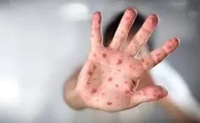 За тиждень в Україні на кір захворіли 1600 осіб