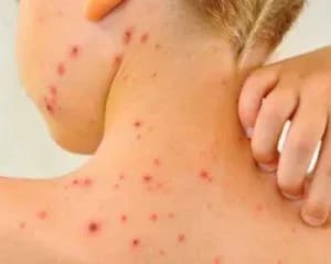 Вспышка кори: в двух школах Винницкой области приостановили обучение