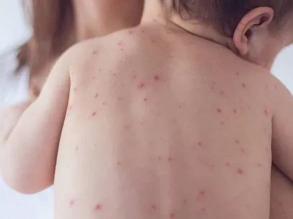 Хворих на кір в Україні за тиждень побільшало на третину