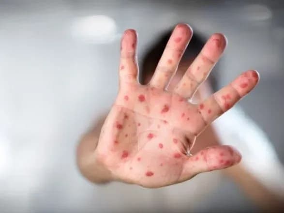 У комітеті нацбезпеки розповіли, коли займуться питанням епідемії кору