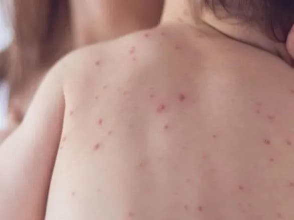 Нардепи хочуть скликати РНБО для оголошення епідемії кору