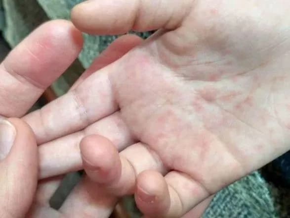 У чотирьох міністерствах України зафіксовано випадки кору