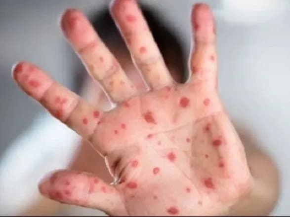 У Львові оновили інформацію щодо кількості хворих на кір