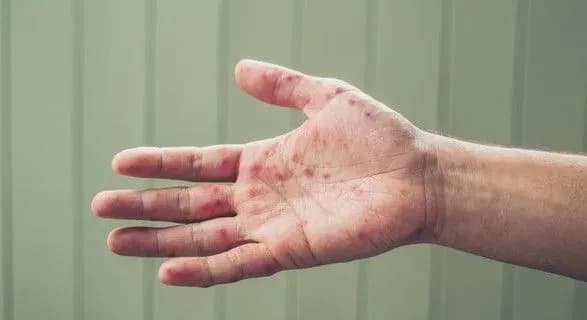 В Украине с начала года 35 тыс. человек заболели корью