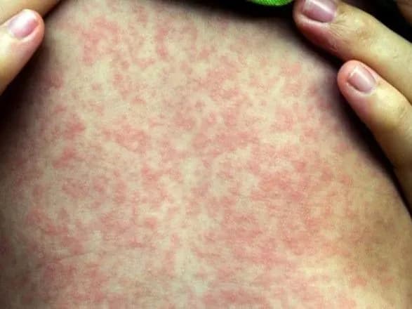 Спалах кору у США став другим за кількістю випадків за 25 років