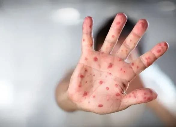 З початку року на кір захворіло понад 47 тисяч українців