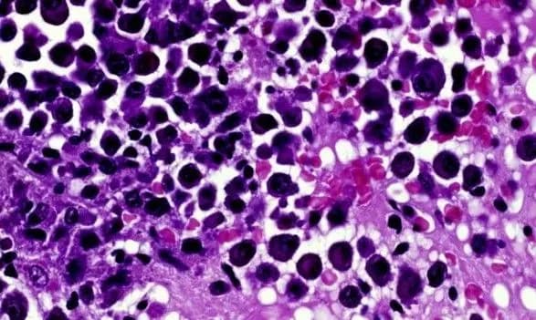 Новые лекарства позволят нейтрализовать самые стойкие раковые клетки