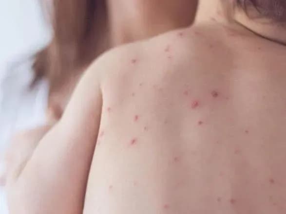 У Рівненській області від кору померла тримісячна дитина