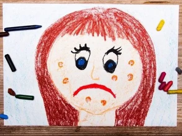 Захворюваність на кір знову зростає: за тиждень майже 300 хворих