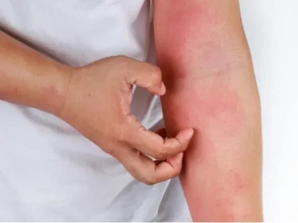 14 сентября отмечается Всемирный день атопической экземы