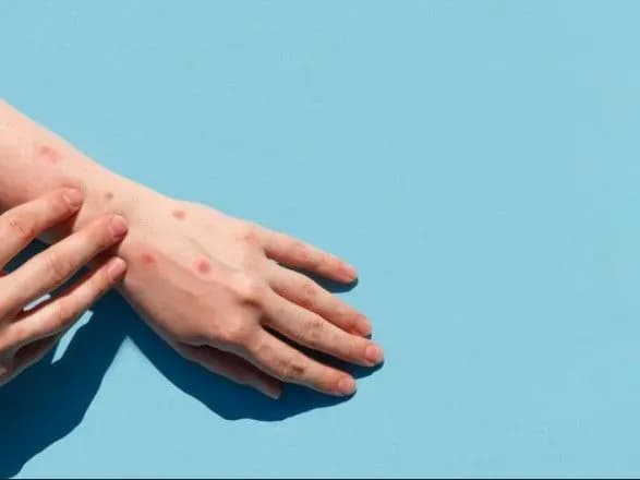 В Україні підтвердили перший випадок віспи мавп