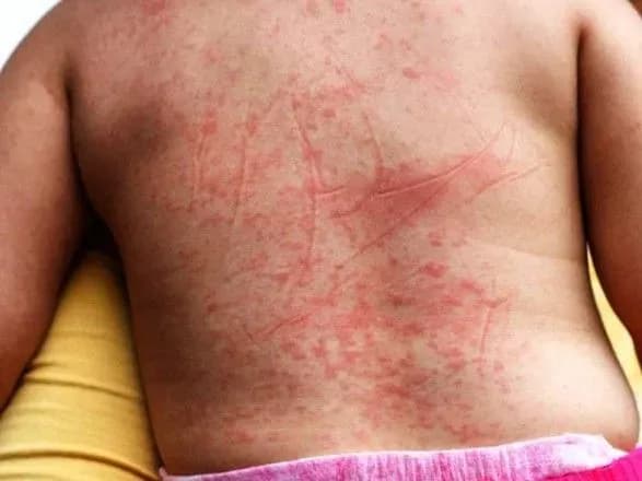 Спалаху скарлатини в Києві немає: інфекціоністи запевняють, що випадки захворювань не пов’язані