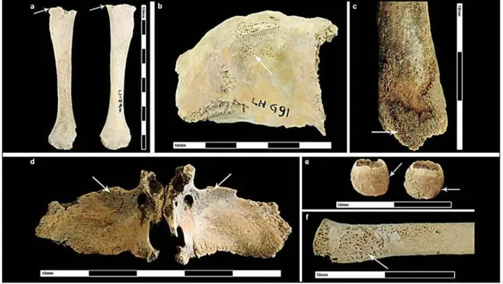 Scientists have found that the urbanization of the Roman Empire led to a sharp deterioration in the health of Britons
