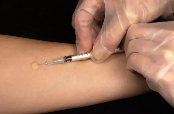 Ukraine abandons Mantoux test - how will tuberculosis be detected in the future