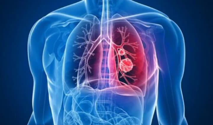 A new drug against aggressive lung cancer reduced the risk of death by 54%