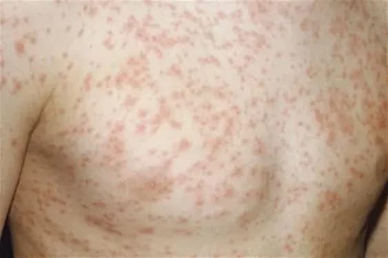 u-kiyevi-zareyestrovano-54-vipadki-zakhvoryuvannya-na-kir