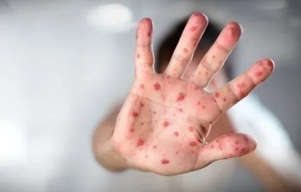 suprun-zayavila-scho-v-ukrayini-nemaye-epidemiyi-koru