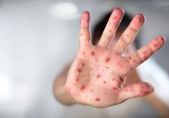 z-pochatku-roku-na-kir-v-ukrayini-zakhvorili-ponad-5-tisyach-osib-moz