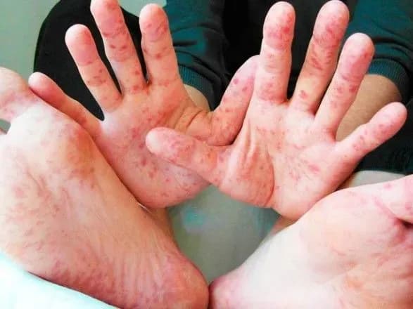 v-kiyivskiy-oblasti-vid-koru-pomerla-ditina