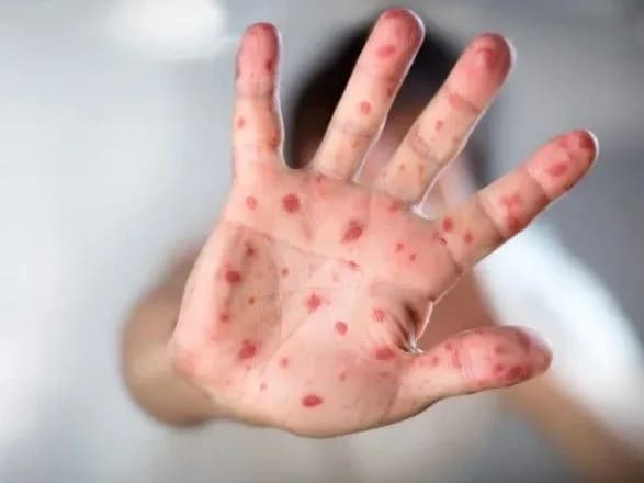 kilkist-khvorikh-na-kir-v-ukrayini-zrosla-za-tizhden-na-28