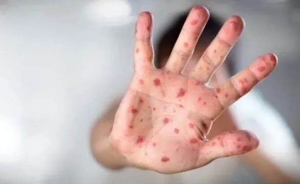 spalakh-koru-na-odeschini-kilkist-khvorikh-ditey-zrosla