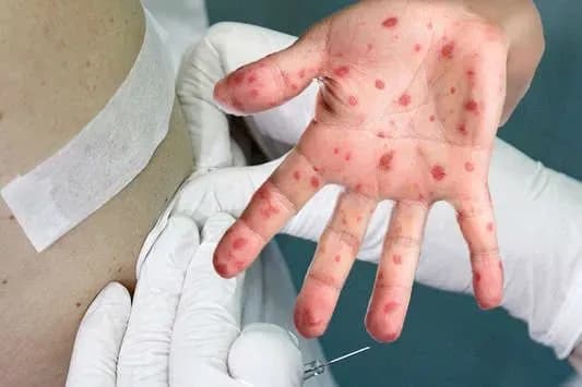 z-pochatku-roku-vid-koru-pomerlo-vzhe-shestero-osib