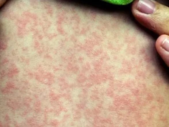 vid-uskladnen-koru-z-pochatku-roku-v-ukrayini-pomerli-16-lyudey