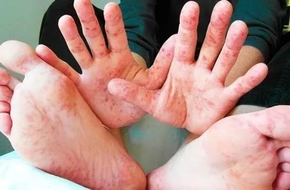 za-tizhden-na-kir-v-ukrayini-zakhvorili-345-osib