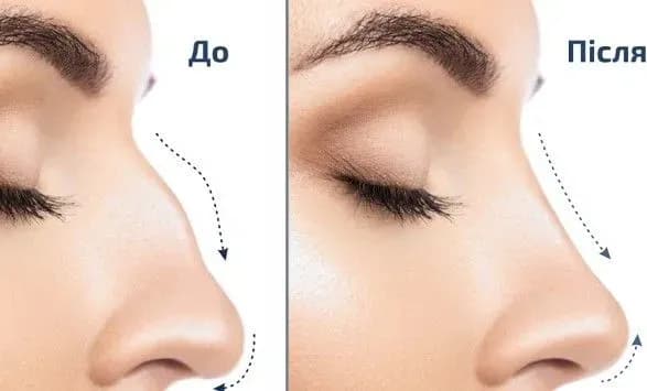 plastichniy-khirurg-cherez-maskoviy-rezhim-zhinki-vse-chastishe-stali-robiti-rinoplastiku