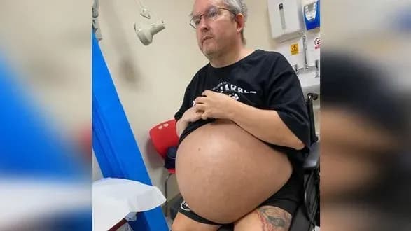 u-velikiy-britaniyi-patsiyentu-vidalili-rekordni-nirki