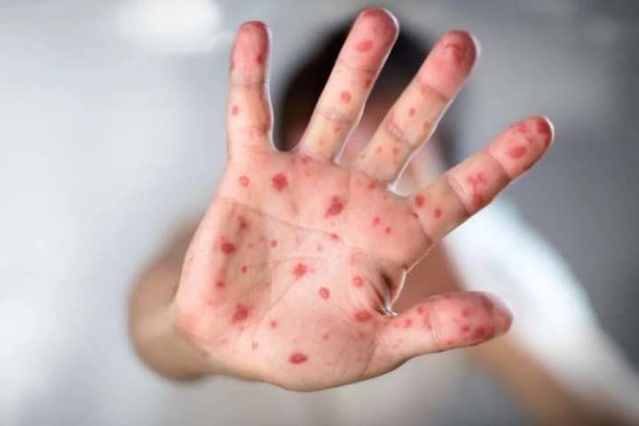 u-himnazii-dnipra-zafiksovano-spalakh-koru-zakhvorily-troie-ditei-z-odnoho-klasu