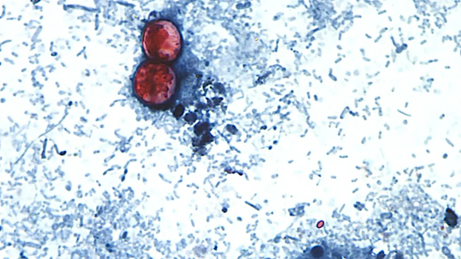 An outbreak of the parasitic infection cyclosporiasis has spread to 31 US states, with the number of cases rapidly increasing