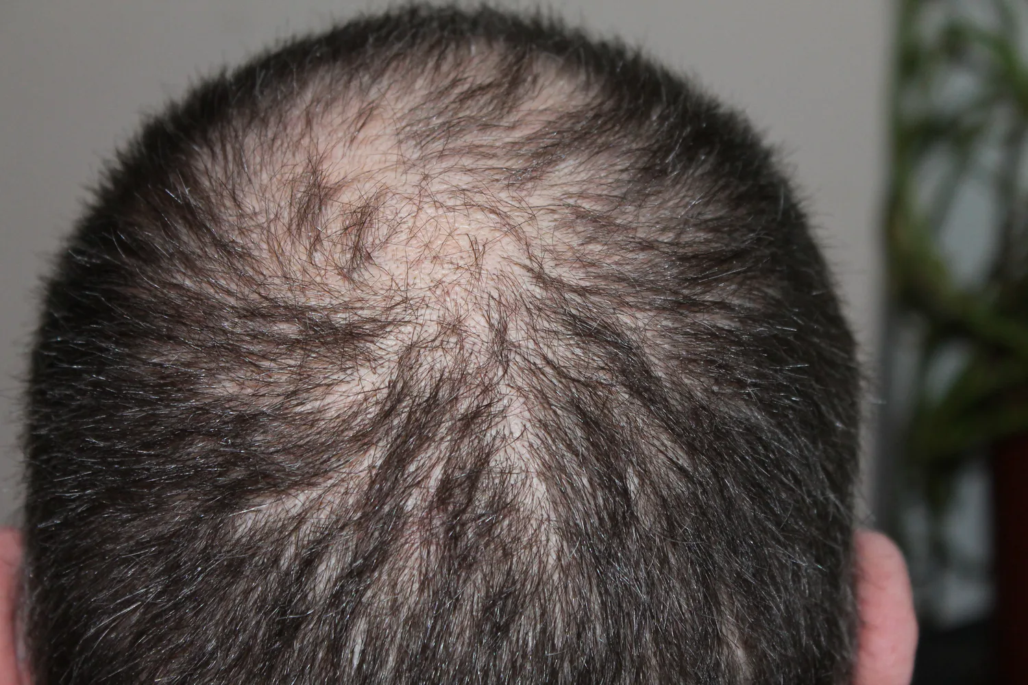 hair loss tirzepatide Let’s talk aboht and hair shedding while taking and semaglutide: @nutrafol The risk of hair loss