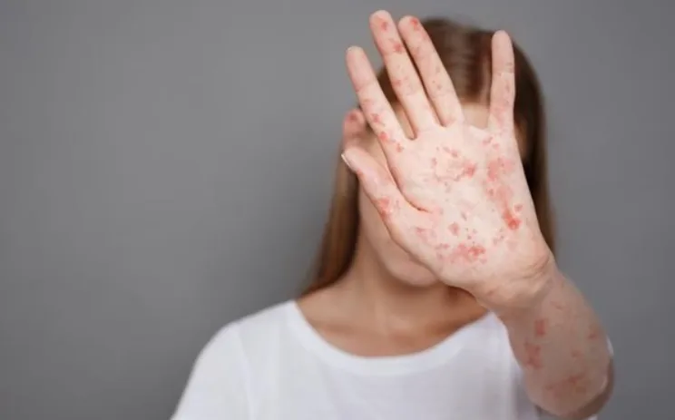 In the US, the number of measles cases has reached its highest level in 35 years – BBC