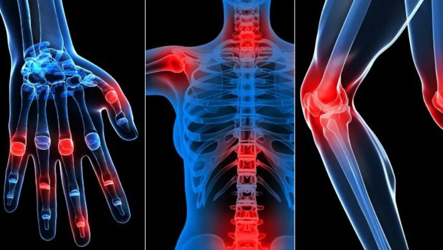 In the United States, a way to restore damaged cartilage has been found: scientists are talking about treating arthritis without surgery